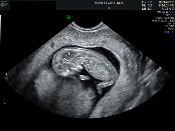 down syndrome baby ultrasound